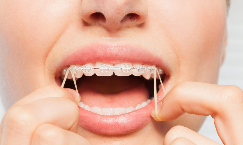 Braces with rubber bands