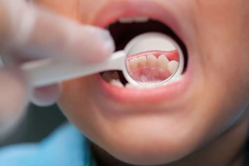 Gingivitis in Children: Early Care for Children Oral Health